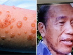 Jokowi Dikabarkan Derita Sindrom SJS: Bisa Disebabkan oleh Obat Antikejang, Ini Gejala dan Bahayanya