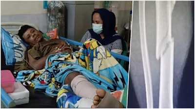 Tahanan di Luwu Patah Tulang karena Dianiaya 3 Oknum Polisi, Kaki Dipukul Balok Kayu