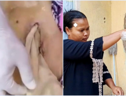 Kisah Pilu Lansia di Bekasi: Meninggal Usai Operasi, Kasa Tertinggal di Perut Tanpa Dijahit!