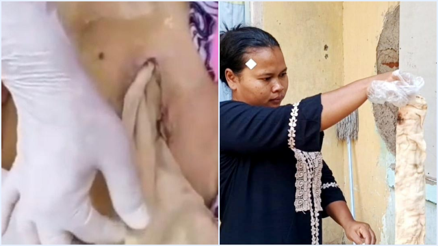 Kisah Pilu Lansia di Bekasi: Meninggal Usai Operasi, Kasa Tertinggal di Perut Tanpa Dijahit!