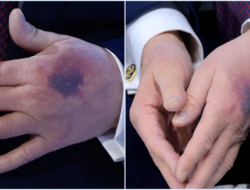 Donald Trump Klarifikasi Tangan Memar di Davos: Dampak Aspirin Dosis Tinggi untuk Jantung